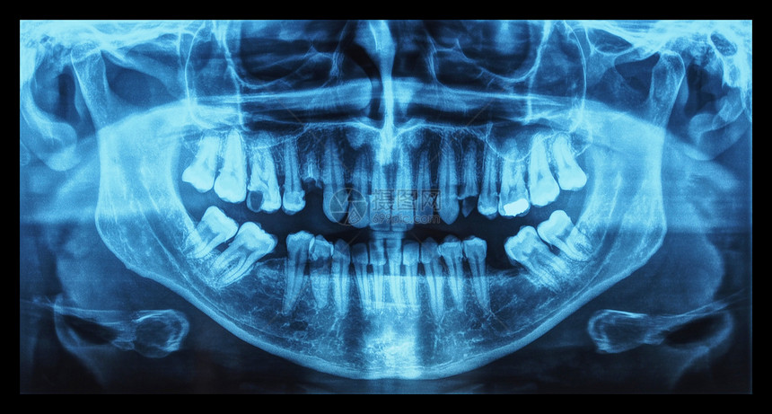 医疗X光人体牙齿的医学X光成像图片