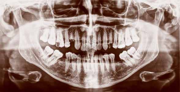 医疗X光片人体牙齿的医学X光成像图片