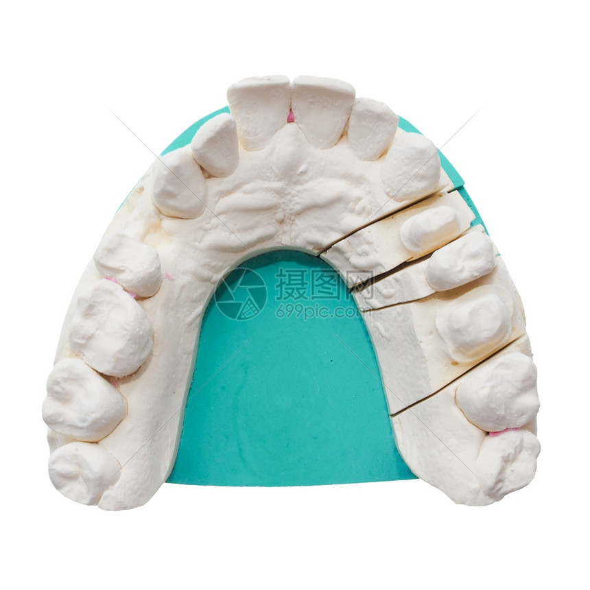 阳牙齿科假的复制是因齿被白隔绝的阴牙齿印象而形成的图片