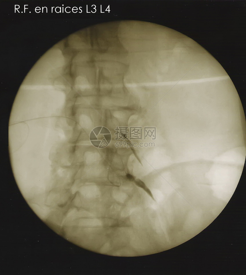 根底脊椎射电图图片