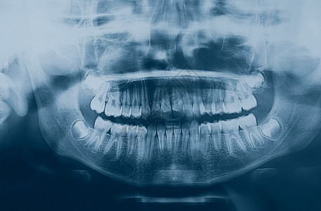 医疗X光儿童牙齿的X光成像图片