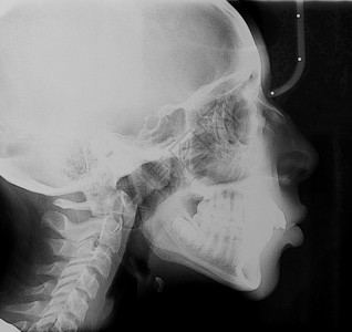 医疗X光儿童头骨牙齿和脊椎的医学X光成像图片