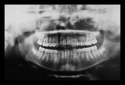 医疗X光儿童牙齿的X光成像图片