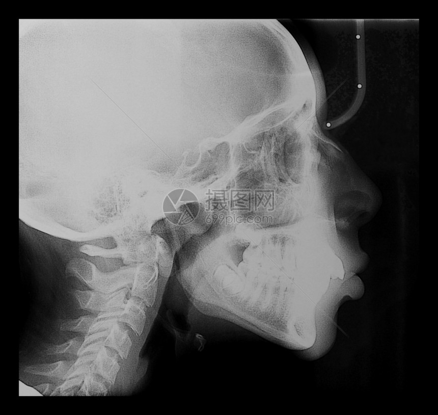 医疗X光儿童头骨牙齿和脊椎的医学X光成像图片