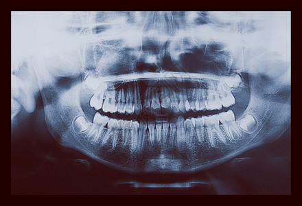 医疗X光片儿童牙齿的医学X光成像背景图片
