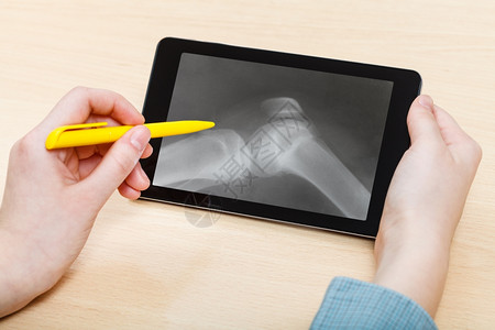 学生在平板电脑屏幕上分析人的膝合影X光照片图片