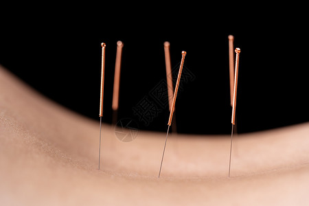 在针刺治疗过程中用钢针头缝紧女背部图片
