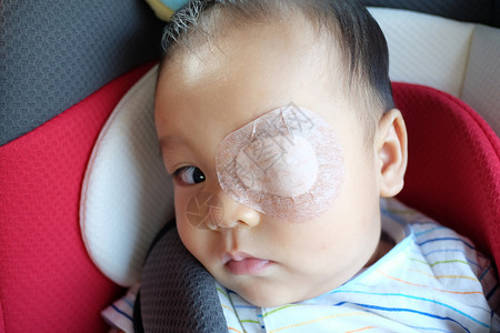 亚洲婴儿是strabismus眼睛闭着以便接受身体治疗图片