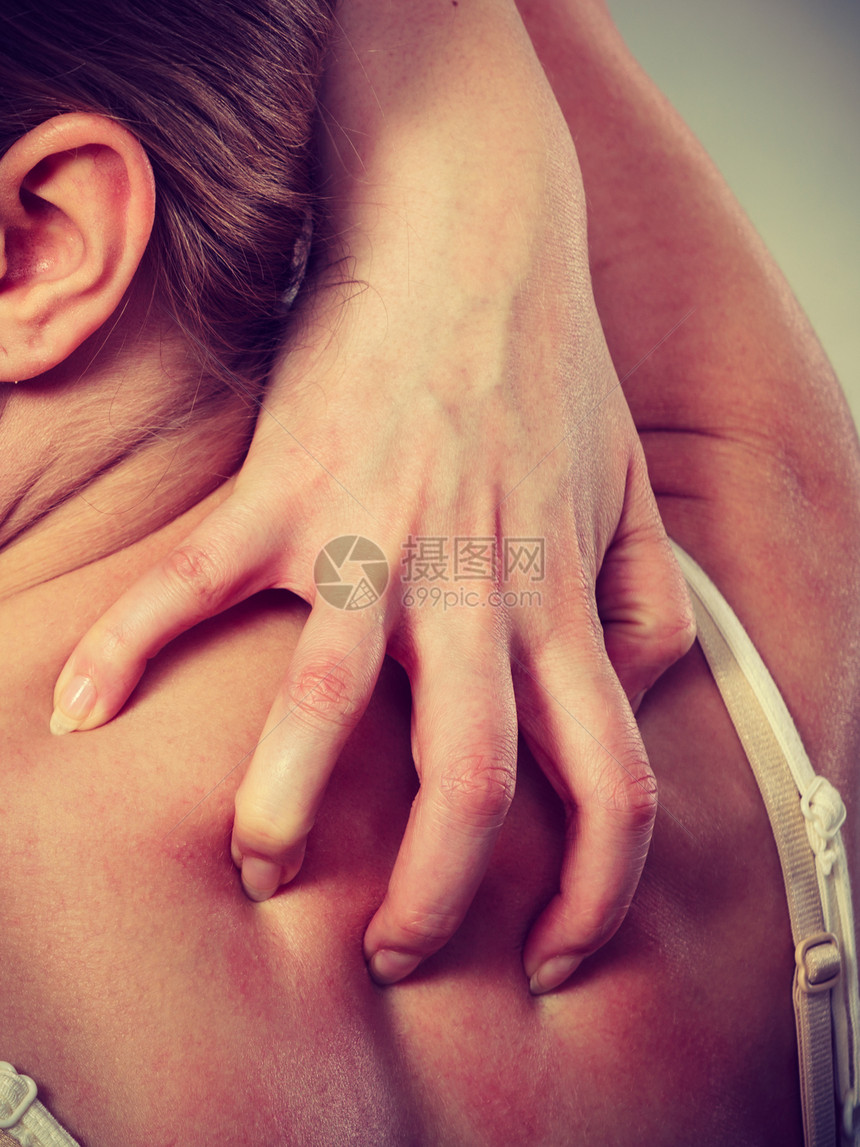 年轻女人用过敏皮疹痒的背部女用过敏皮疹痒的背部图片