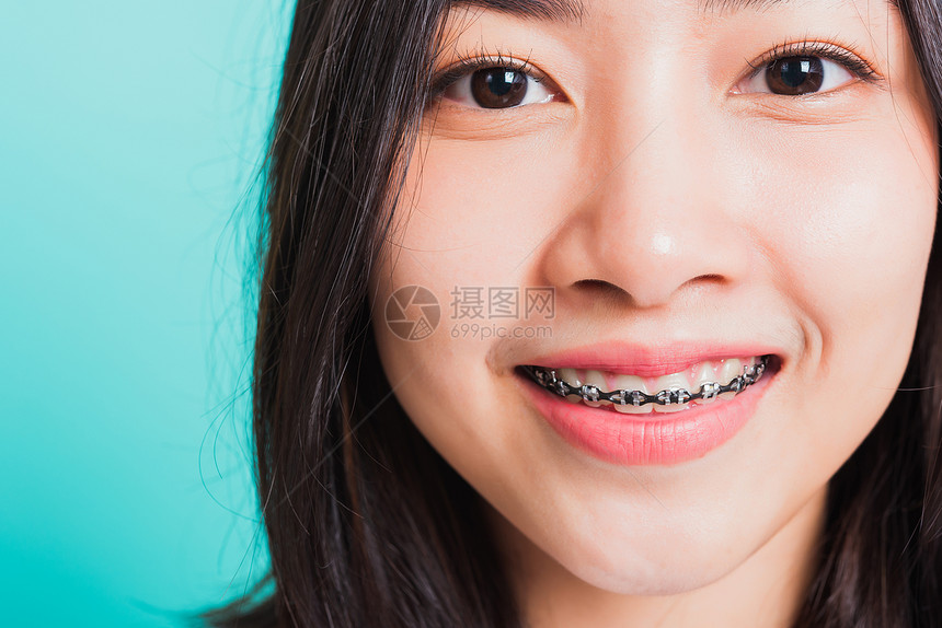 紧关近身的亚裔年轻美女微笑牙齿套在上笑摄影棚拍在蓝背景上被孤立药物和牙科女口腔概念图片