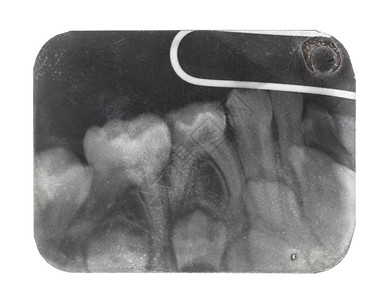 以X光胶片拍摄人类牙齿的X光图像图片