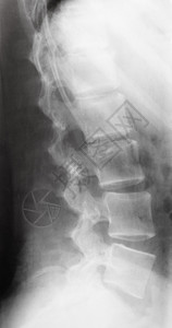X射线图像中的人类脊椎侧视图图片