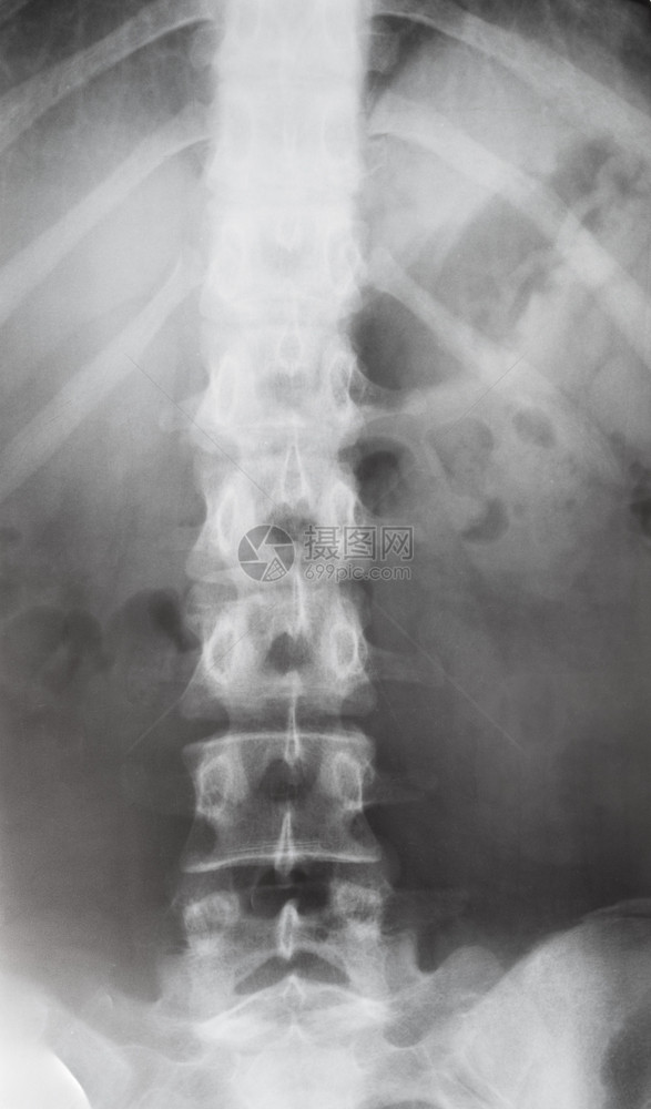 X射线图象X的躯体中人类脊椎前部视图图片