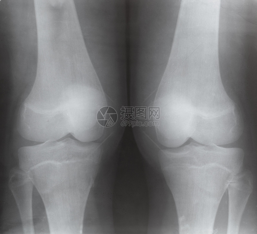 X光图像上两个人的膝关节前视线图片