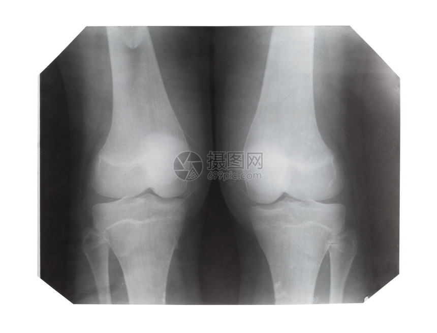 白色背景上隔离的两膝前视镜X光胶片图片