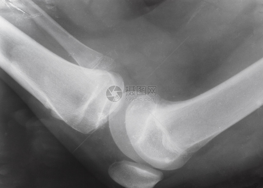 人的膝盖侧面与X光图像上的天窗图片