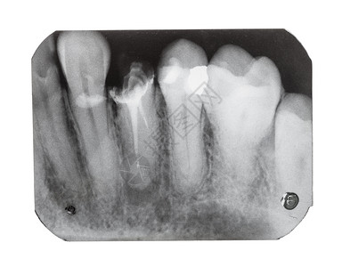 带X光胶片的人类牙齿X光图像针紧与白色背景隔绝图片
