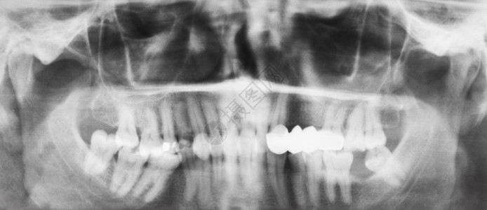 在X光图像上戴牙冠的齿图片