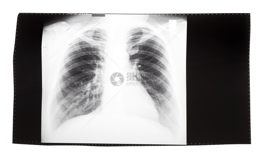 白色背景上隔离的人类胸部前视图的X光胶片像图片
