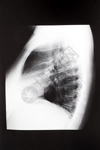 X射线图像中肺部的人类胸侧面视图图片