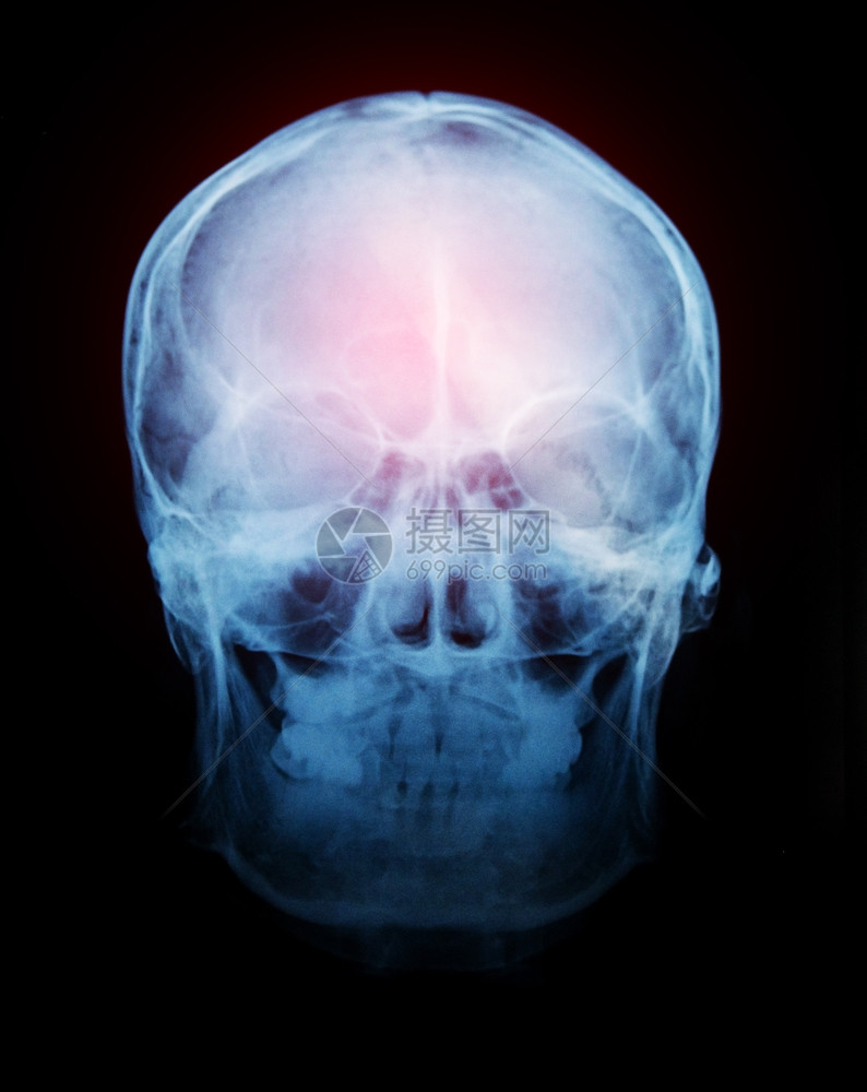 核磁共振男人身体头骨X光片图片