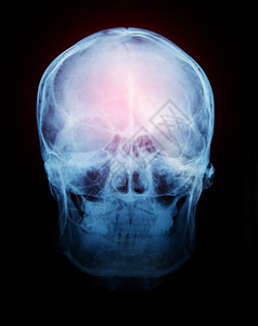 核磁共振男人身体头骨X光片图片