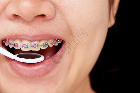 女孩带着牙套微笑泰国青少年牙医图片