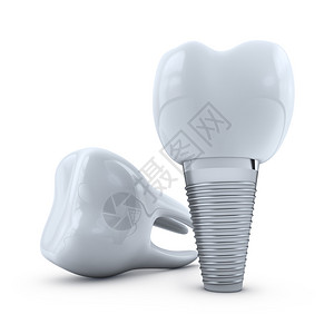 假体凹痕医疗的白色背景上牙齿植入物和臼3d渲染口腔科设计图片