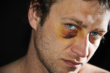 挫伤男白种人眼部受伤的男子图片