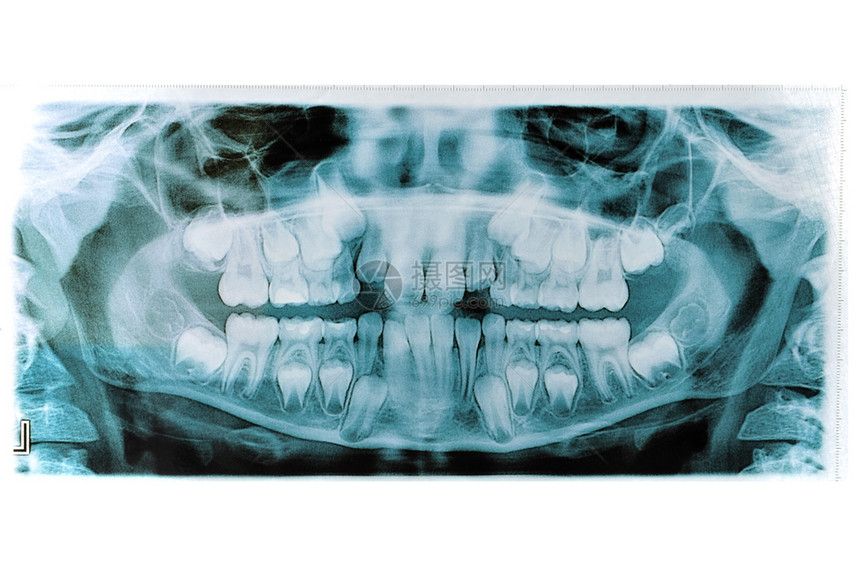 疾病牙齿白上孤立的下巴X射线牙科图片