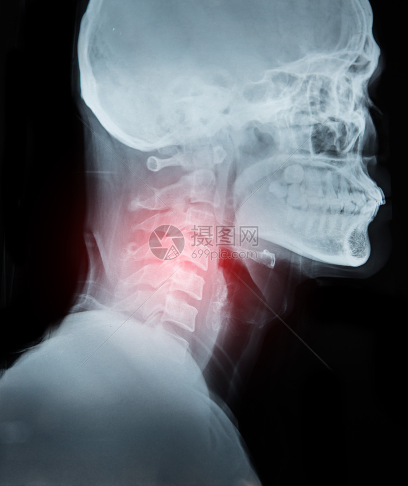 X光图像胶片关于颈部疼痛和红区的细节解剖学电影X射线图片