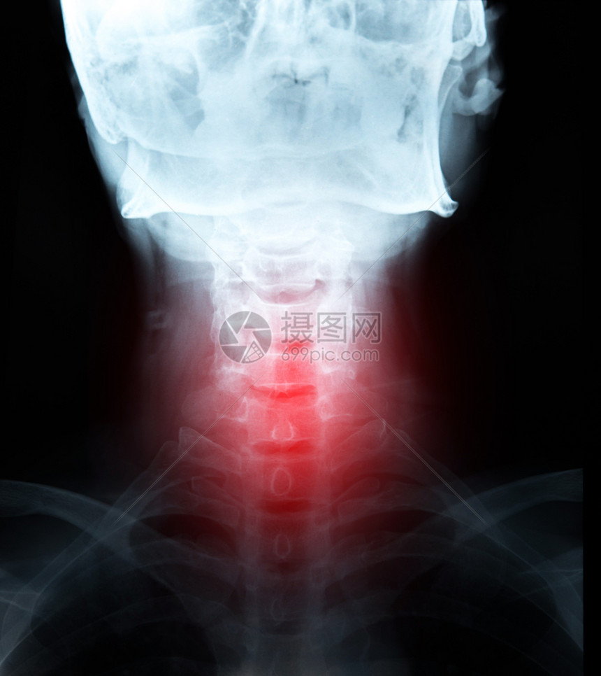 医院X光图像胶片关于颈部疼痛和红区的细节电影脖子图片