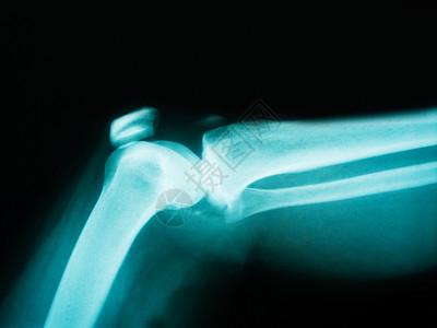 药物诊断显示骨折的人体手臂X光片射线图片