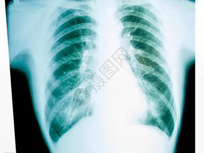 一种卫生保健对男胸部的X光片骨骼图片