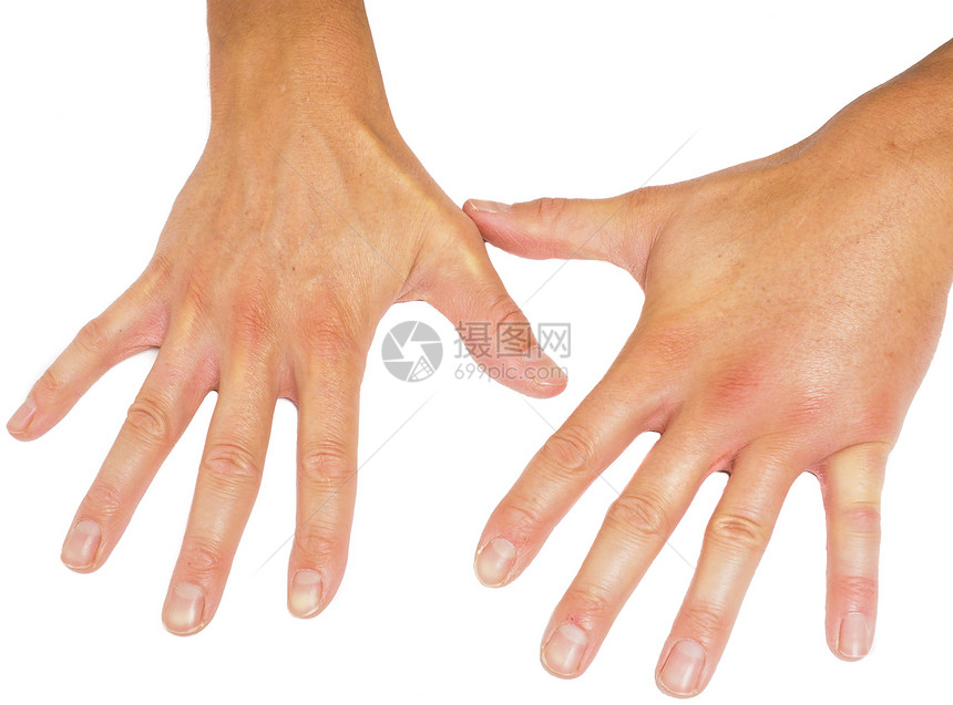 痛昆虫疮将肿胀的男双手与白种相比将其孤立于白种背景图片