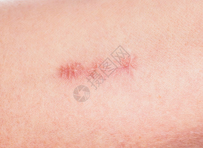 药物皮肤缝合伤口周围的红色紧闭手臂医院图片