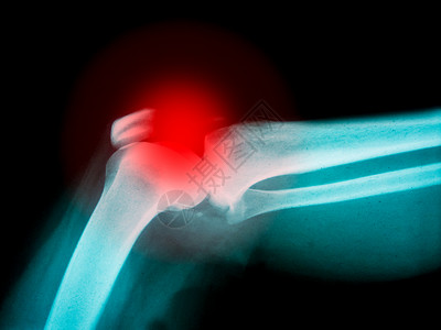 弯头电影经过人体手臂X光片显示骨折和红亮点高清图片