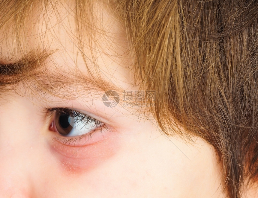 童年粉红眼睛对一个男孩子与棕色眼睛和黑褐头发的紧闭皮肤考试图片