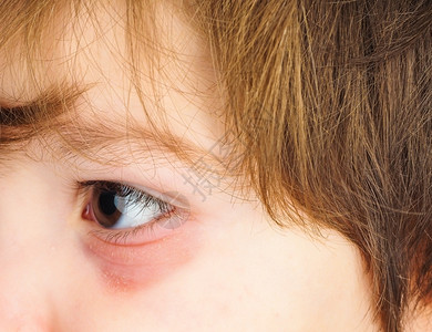 童年粉红眼睛对一个男孩子与棕色眼睛和黑褐头发的紧闭皮肤考试图片