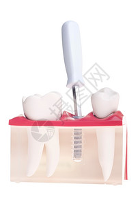 植入式牙科模型与白种背景隔离的螺丝起子机安装药物门户14治疗图片