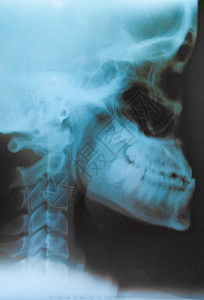 关节炎测试骨骼黑白X光胶片上的人类头部图片
