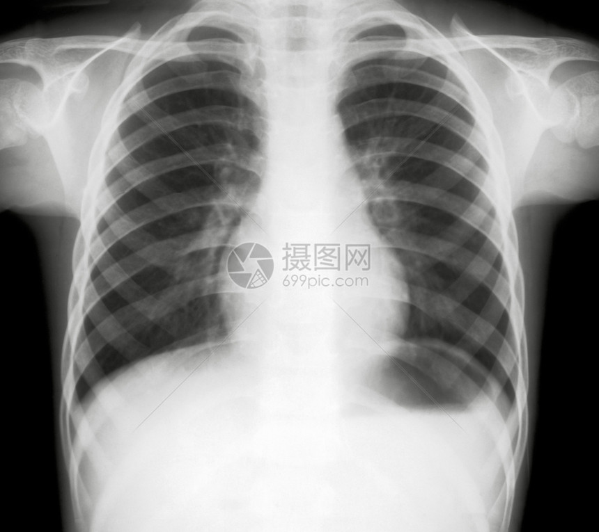 身体医疗的X光照人胸部X片医生图片