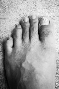 脚丫子用真菌的指甲钉迷魂药贴近疾病健康图片