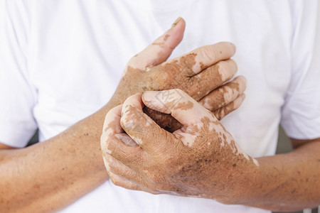手上的白癜风老年人皮肤手上贴近的维蒂里戈导致皮肤斑块消化的健康状况人们白癜风紊乱背景