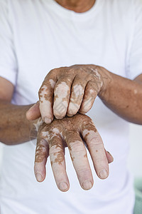 手上的白癜风斑驳的黑色素细胞老年人皮肤手上贴近的维蒂里戈导致皮肤斑块消化的健康状况白癜风背景