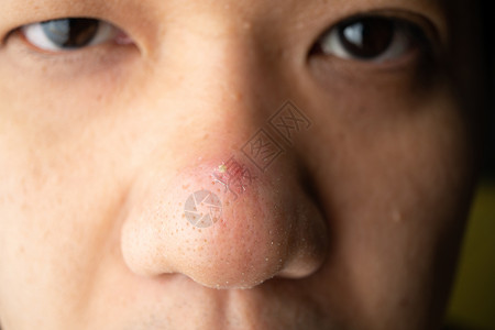肛门镜关闭了亚洲皮肤脸部鼻子上许多黑头皮条和肛门伤疤美丽瘢痕细节背景