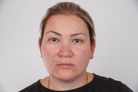 激素卫生保健头发护理一位患有荷尔蒙紊乱的妇女肖像图片