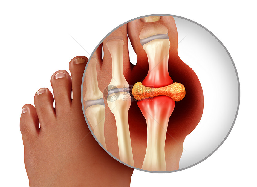 一种手术以3D插图样式作为治疗和诊断白种背景孤立的慢疼痛高血糖贫象征指脚趾紧贴人的作为治疗和诊断白种背景下的慢疼痛标志类风湿图片