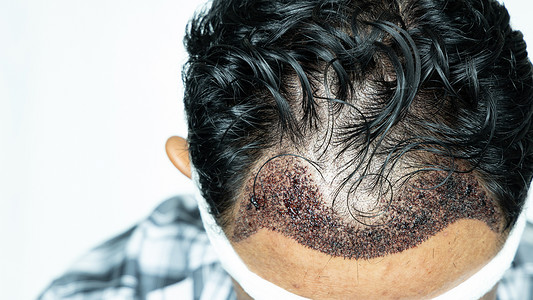 健康头部做发移植手术的人有后发线FUUE软体细胞抽取理发手术类型及其各阶段的头发移植手术者种园乐器背景