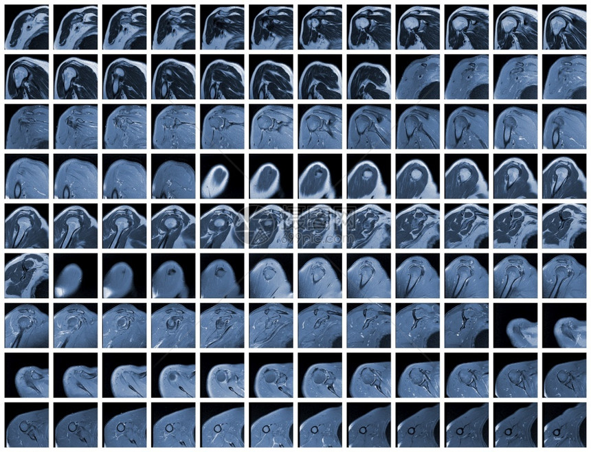 右肩关节全磁共振联合的人类末端图片